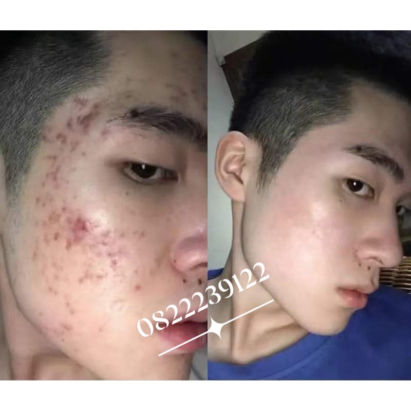 Noãn thực vật QA Beauty loại chuyên cho spa