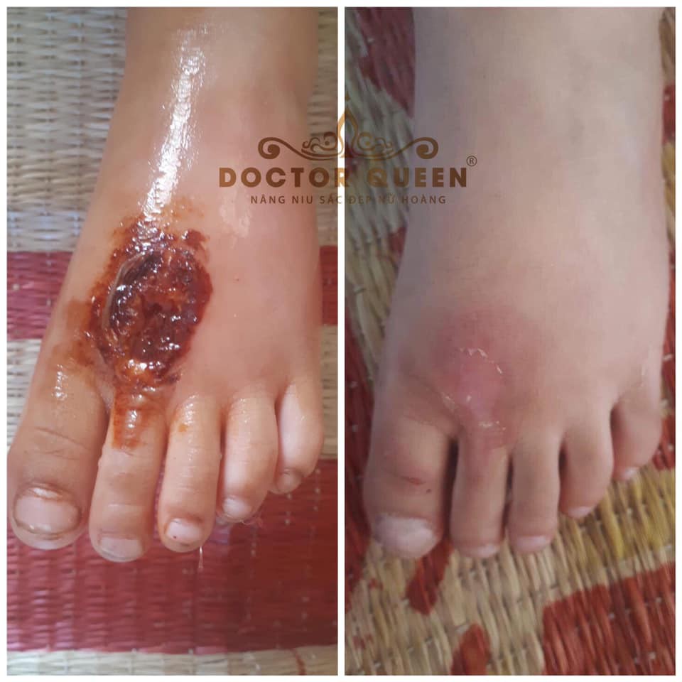 CAO NGHỆ DOCTORQUEEN (ngừa thâm nám,mụn,bỏng,sẹo,ngã xe các vết thương,...làm sáng da,)