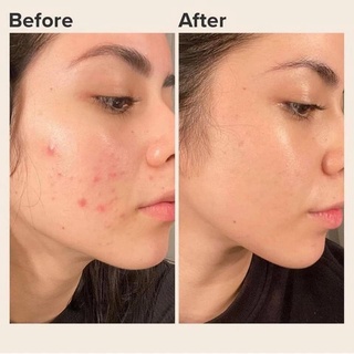 KEM GIẢM MỤN DERMA FORTE