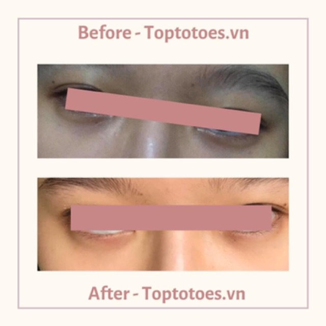 Serum vùng mắt Teana Eye Contour Perfector Serum giảm nhăn, bọng, thâm mắt