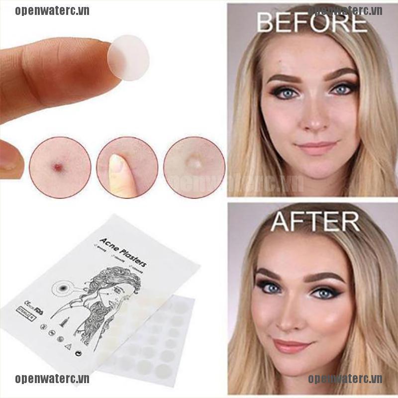 OPC 36Pcs Skin Tag & Acne Patch Hydrocolloid Acne and Skin Tag Remover Patches