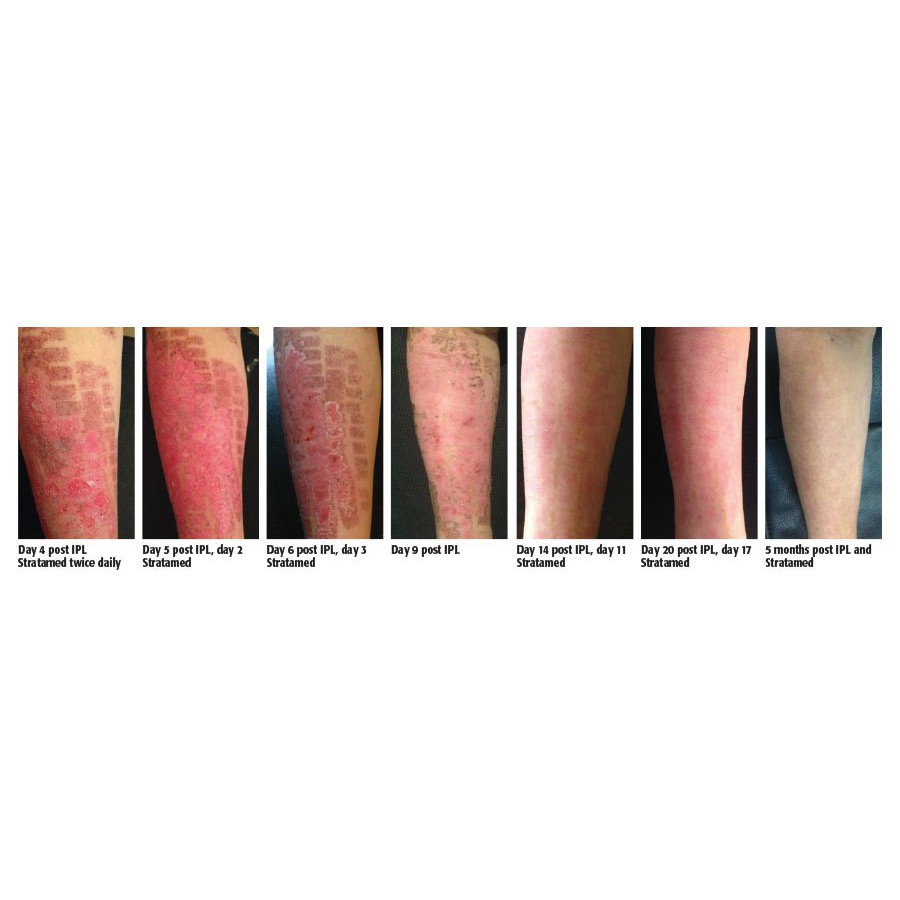 Stratamed ngừa sẹo ngay từ khi sẹo chưa hình thành cho hiệu quả vượt trội