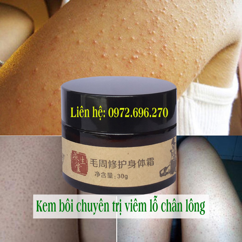 Kem bôi da rắn - da vảy ca - da gà [ Cực hiệu quả ]