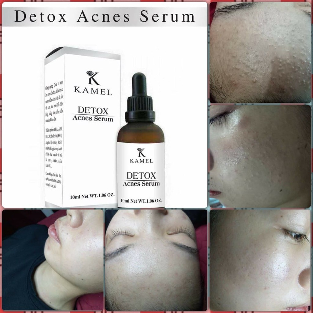 [Sẵn hàng] Detox Acnes Serum - Serum loại bỏ mụn Kamel 10ml