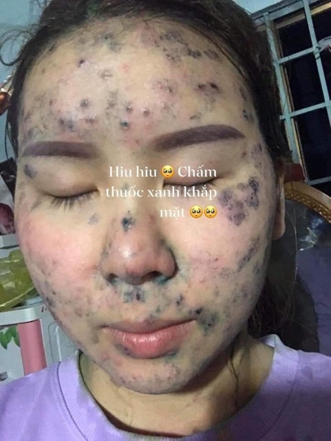 SERUM THANH DƯỢC - LÁRE( MẪU MỚI ) ĐIỀU TRỊ DA TỪ THIÊN NHIÊN | BigBuy360 - bigbuy360.vn