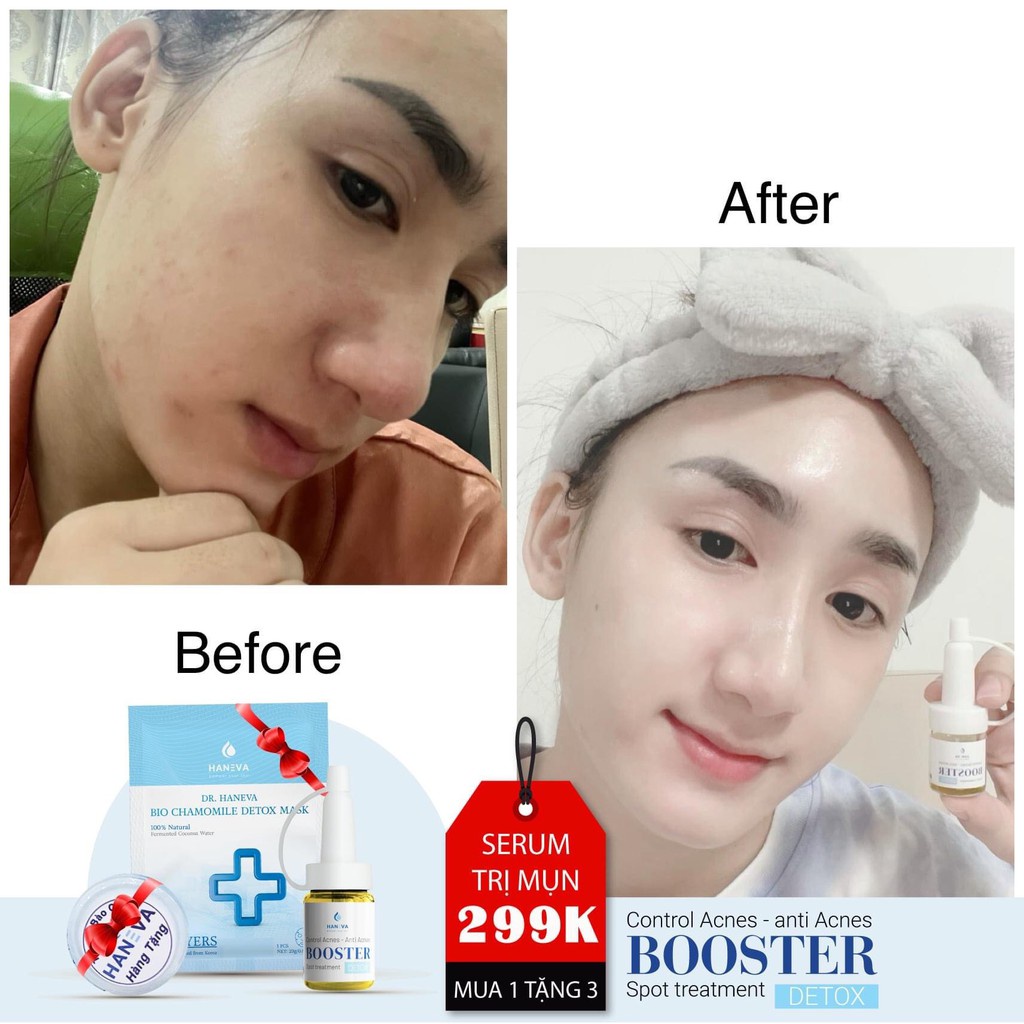 Serum Mụn Booster Detox 5ML - Tặng 5 nạ ngủ collagen