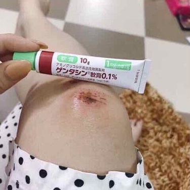 Kem mờ sẹo Gentacin Nhật Bản làm mờ sẹo lồi sẹo rỗ sẹo thâm