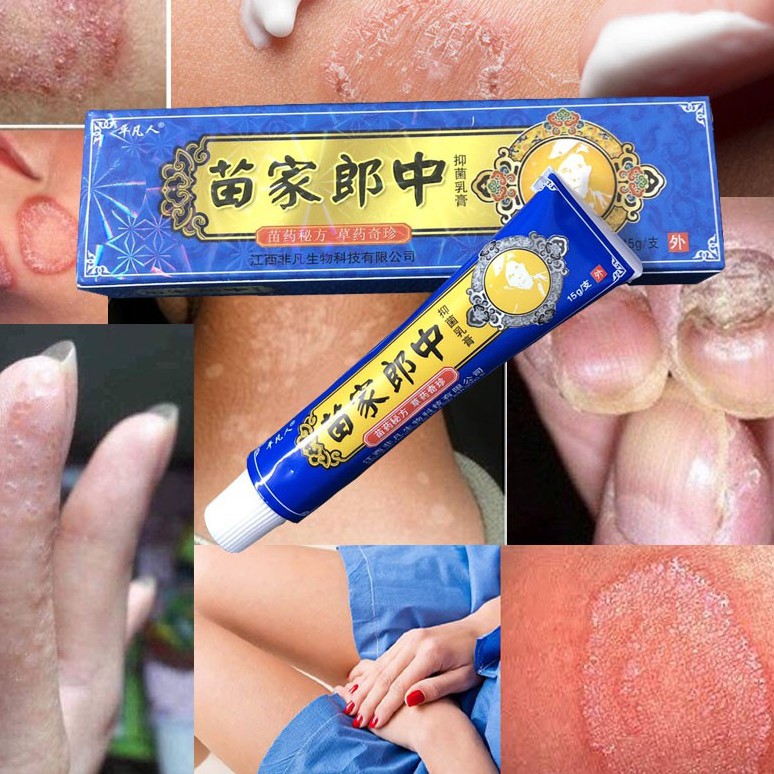 Kem Bôi Á Sừng, Nấm Ngứa, Hắc Lào, Vảy Nến Lang beng, bạch biến, kem bôi hắc lào, á sừng, mề đay, tổ đỉa Hàng có sẵn