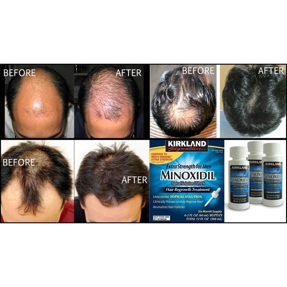 Thuốc mọc râu tóc Minoxidil Chính hãng