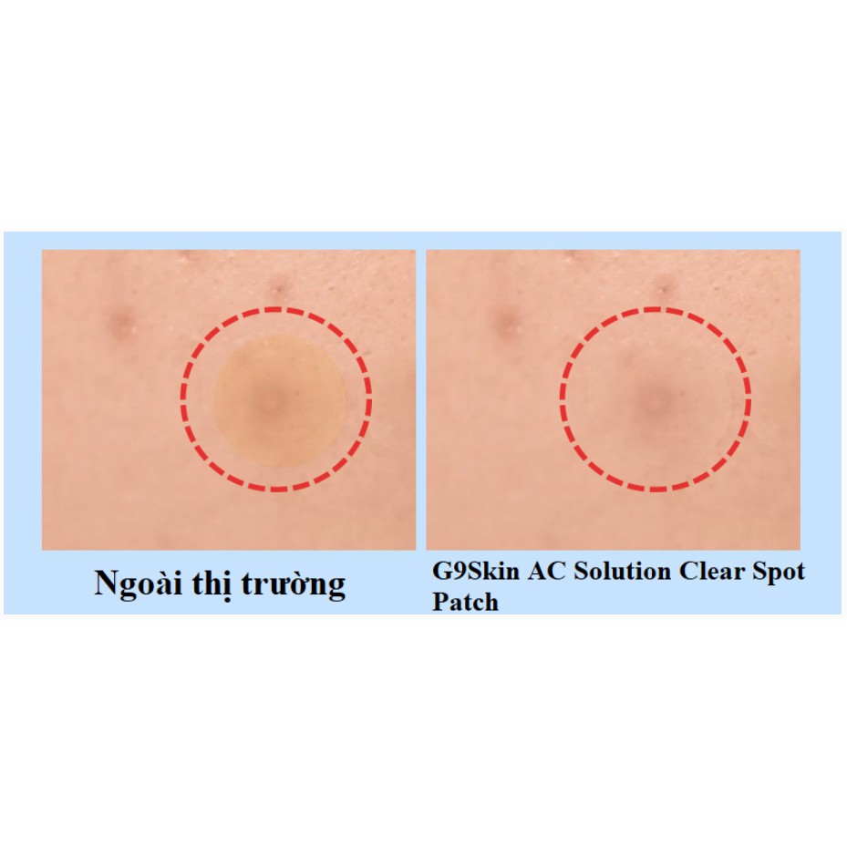 Miếng Dán Hút Mụn Trong Suốt, Chống Nước Suốt 24h G9Skin AC Solution Clear Spot Patch