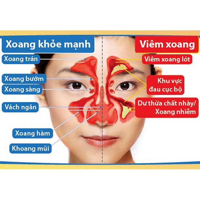 Xoang Việt Extra lọ 30 Viên - Hỗ trợ chữa viêm xoang, tăng sức đề kháng khỏe mạnh 30  viên