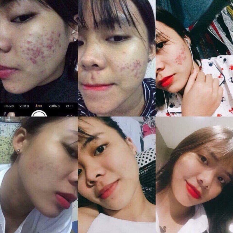 Sạch MỤN THÂM RỖ MT | BigBuy360 - bigbuy360.vn