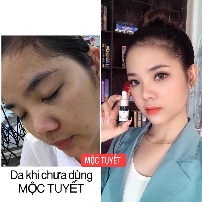 SERUM NGỪA MỤN DƯỠNG DA MỘC    TUYẾT