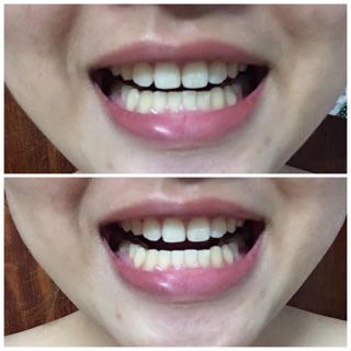 Miếng dán trắng răng Smile cosmetique
