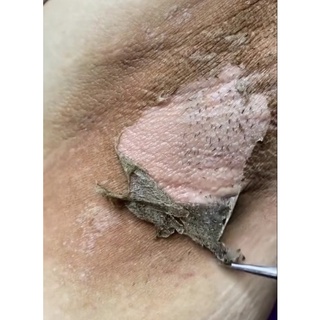 PEEL TCA TRIỆT THÂM NÁCH