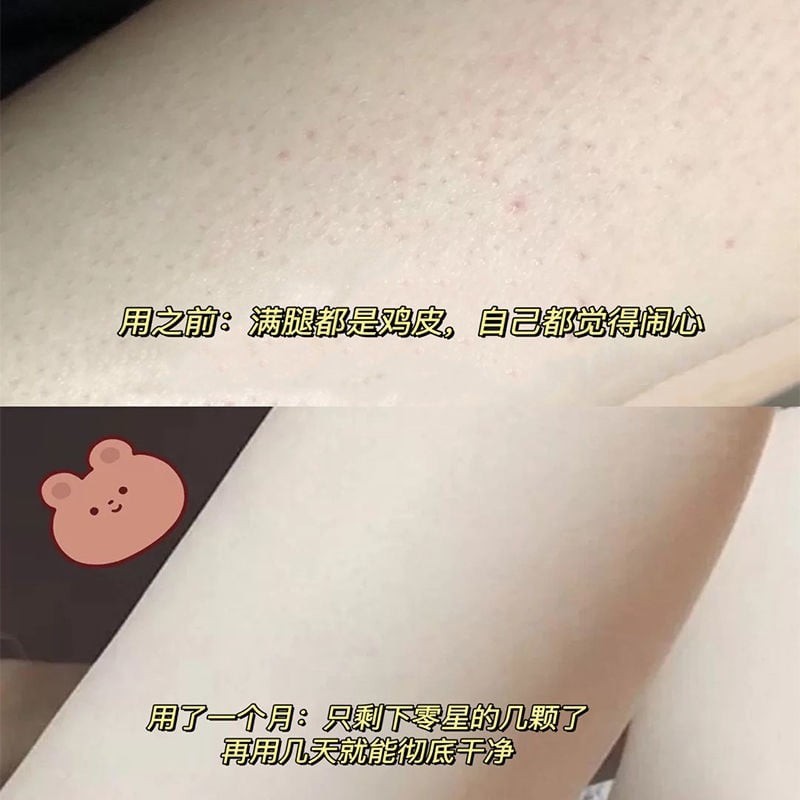 Kem urê sữa dưỡng ẩm giữ ẩm chống nứt nẻ và làm trắng da, viêm lỗ chân lông | BigBuy360 - bigbuy360.vn