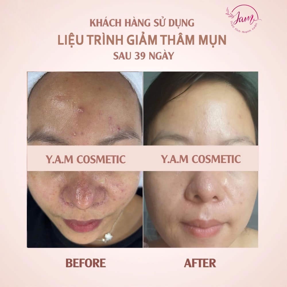 Bộ 3 Giảm Mụn Ẩn Thâm Rỗ YAM Cosmetic Giảm Viêm Sưng Tấy Mụn Đầu Đen Và Sẹo Thâm Sau Mụn Chai 30ml