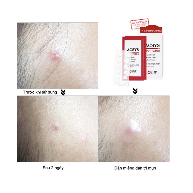 Hộp Miếng Dán Đầu Mụn 72 Miếng SNP Acsys Spot Patch | BigBuy360 - bigbuy360.vn