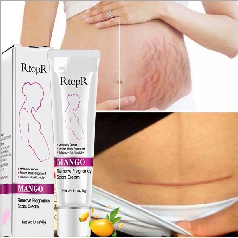 Kem Làm Mờ Rạn Da, Xóa Sẹo Sau Sinh/Rạn Do Tăng Cân Cấp Ẩm Phục Hồi Tái Tạo Da RtopR Mango Remove Pregnancy Scars Cream