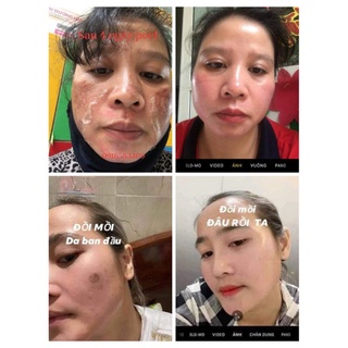 SÉT TCA CHẤM PEEL NÁM TÀN NHANG 35%