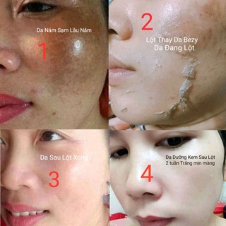 Thay da sinh học xóa sạm nám lâu năm bezy