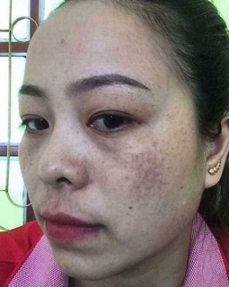 Combo trị nám / tàn nhang tận gốc detox blanc