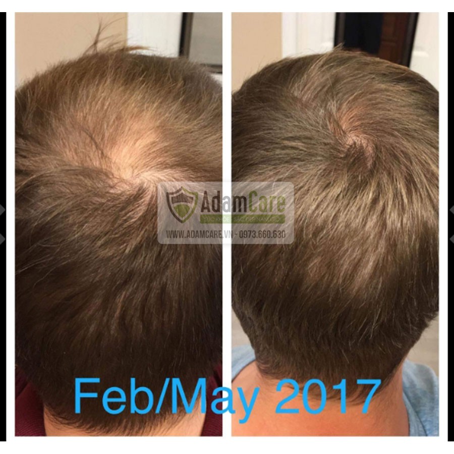 Bột LCLT hỗ trợ mọc râu tóc