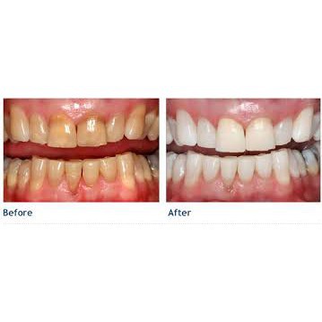 Tẩy trắng răng tại nhà Opalescence 10% 15% 20% 35% chính hãng MỸ