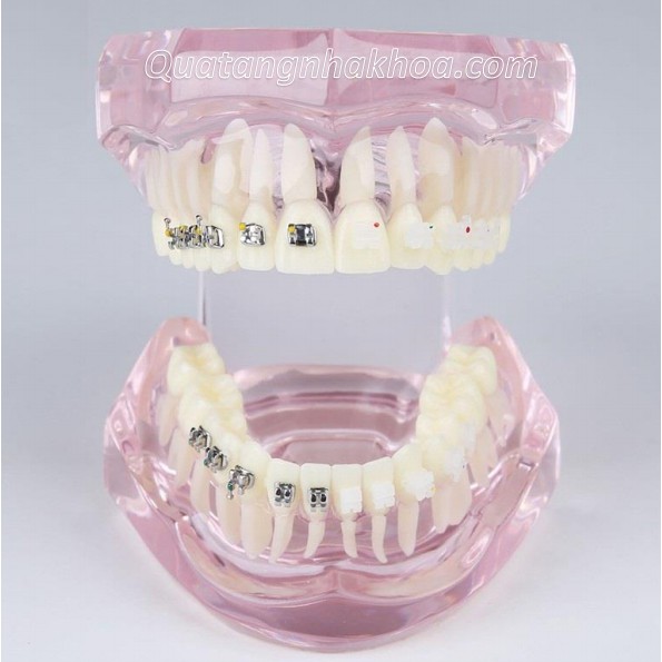 Mẫu hàm tư vấn so sánh chỉnh nha mắc cài kim loại và mắc cài sứ – mô hình nắn chỉnh răng nha khoa
