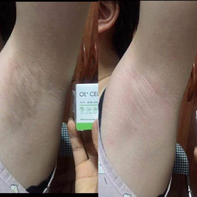Ol Cell kem hút thâm nách, thâm body hàn quốc | BigBuy360 - bigbuy360.vn