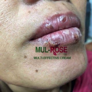 Dưỡng môi , dưỡng da,sẹo,mụn -MULROSE
