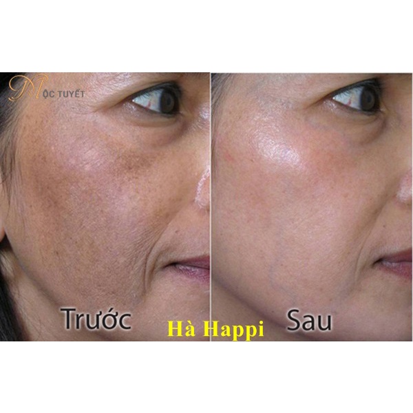Cao nám mật ong Melasma Pro Mộc tuyết chính hãng | BigBuy360 - bigbuy360.vn