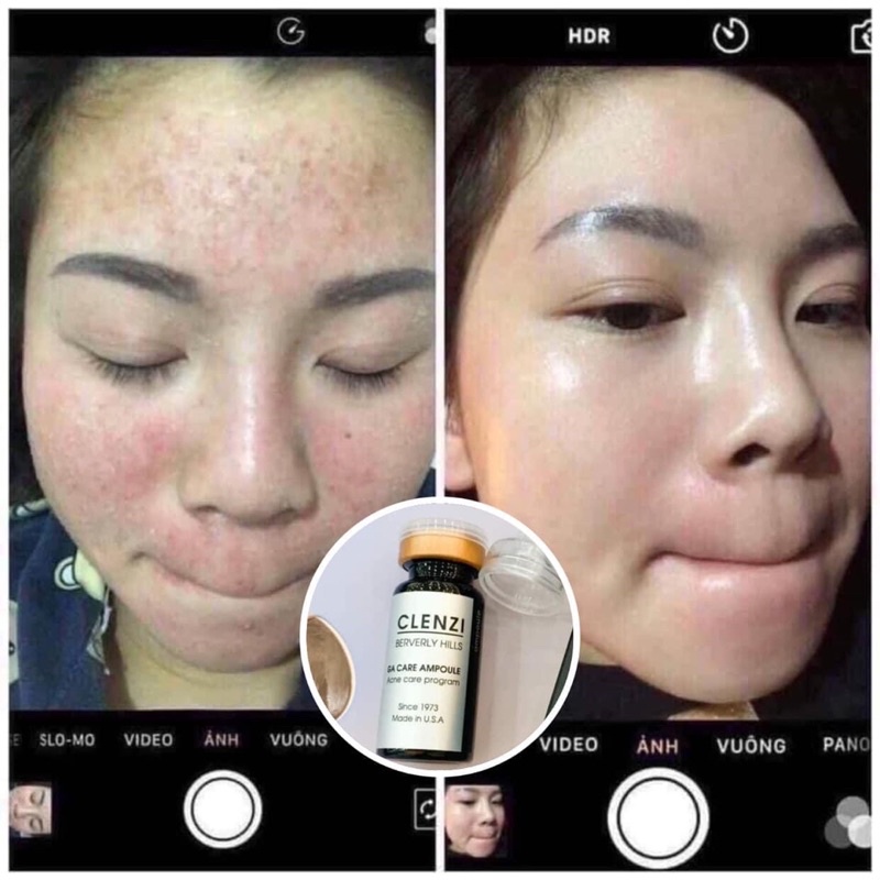 Serum Clenzi Đánh Bay Các Loại Mụn Và Thâm