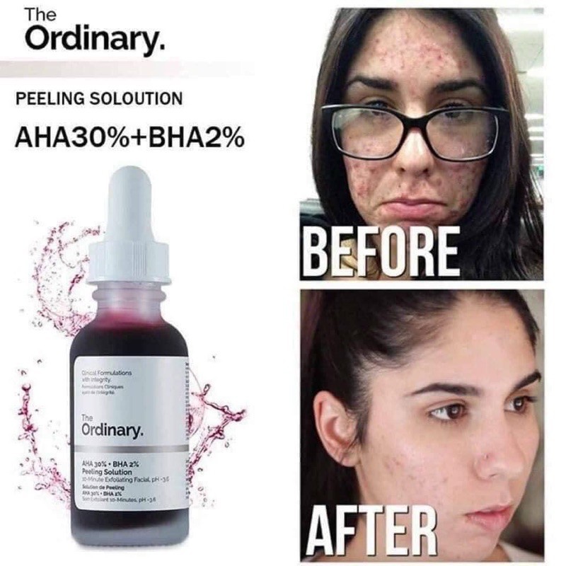 TẨY DA CHẾT HÓA HỌC THE ODINARY AHA 30% - BHA 2% PEELING SOLUTION