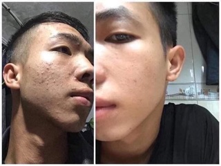 Combo kem mụn và serum Hoa Đào