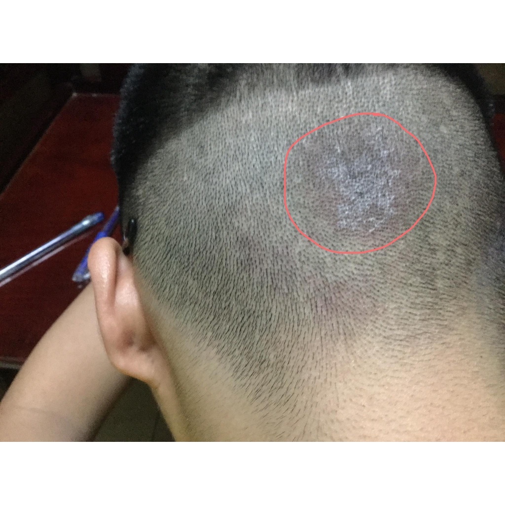 Dược Liệu Nấm Da Đầu Ezema 50 - Chiết Xuất Từ Gurjun Ấn Độ - Thương Hiệu iCare Pharma SACUCO