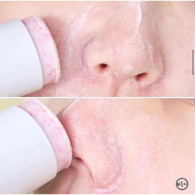THANH LĂN GIẢM MỤN ĐẦU ĐEN [So’Natural Red Peel Clear Stick]