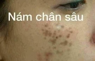 SERUM GON DƯỠNG TRẮNG HỒNG DA
