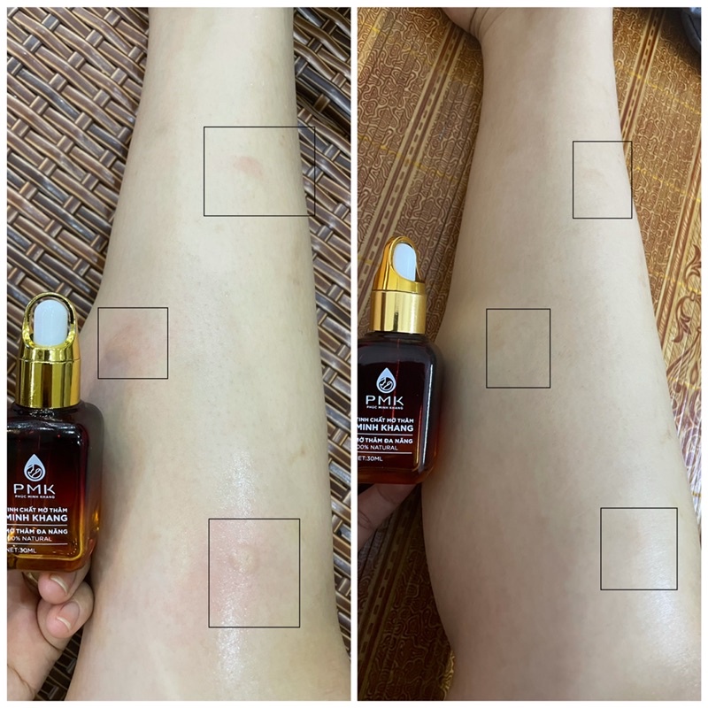 Tinh chất Xóa thâm Minh Khang, Xoá mờ thâm sẹo,thâm mắt, thâm môi,thâm nách,thâm mụn