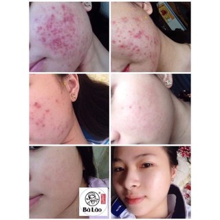 Combo Cao Cấp Bà Lão Serum Mụn Thâm Sẹo Và Đinh Hương Bột Kèm Mặt Nạ Dưỡng