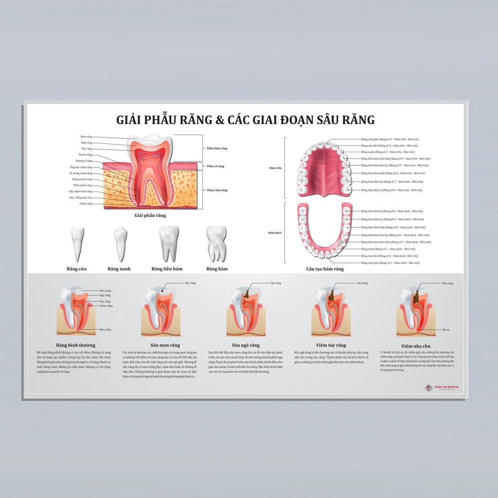 Tranh giải phẫu răng và các giai đoạn sâu răng - 50x75cm - Decal dán