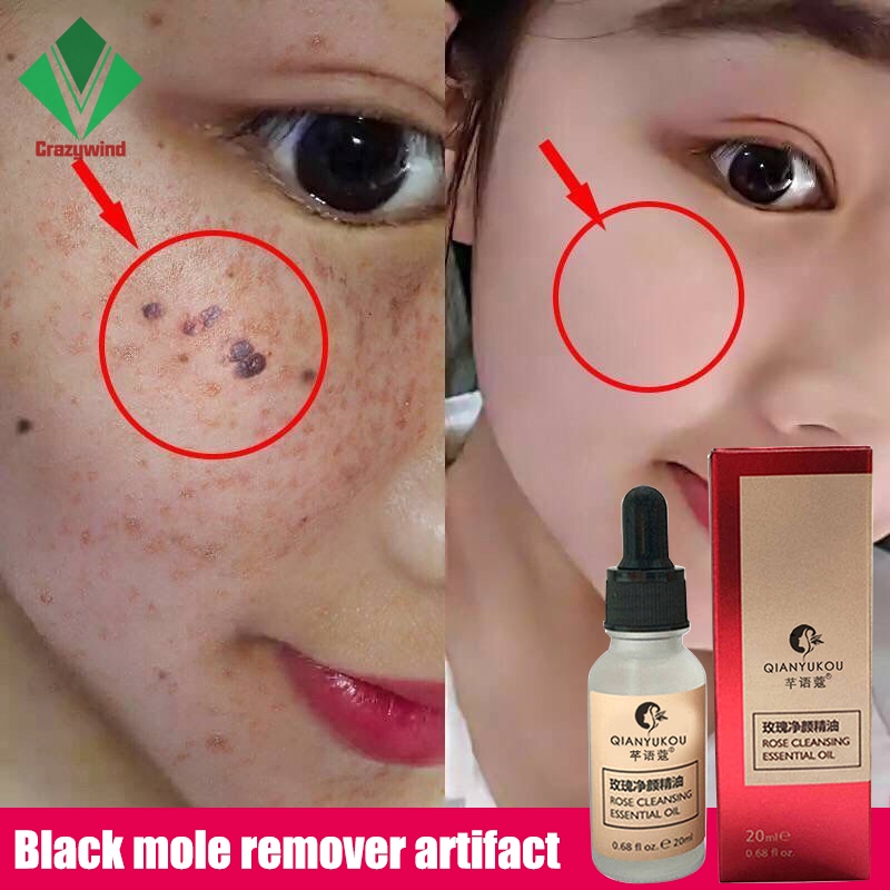 (Hàng Mới Về) Serum Loại Bỏ Nốt Ruồi Và Tàn Nhang Không Đau 20ml