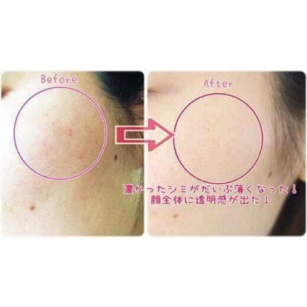 Tinh Chất Làm Giảm, Mờ Nám, Trắng Da Transino Nhật Bản 30g - 50g