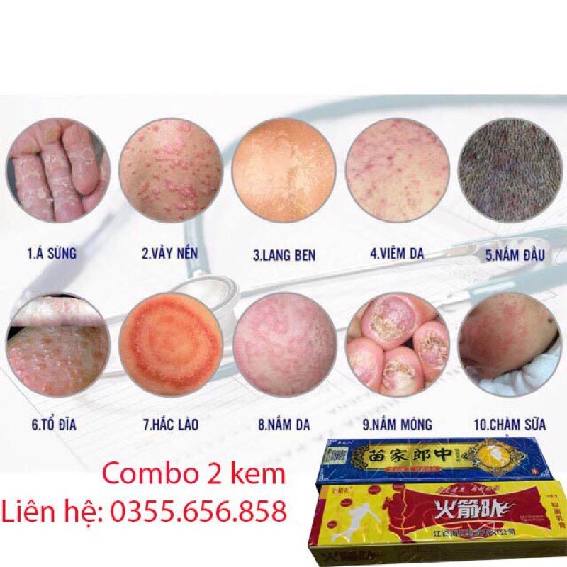 Kem bôi dành cho các bệnh về da liễu(Hàng Sẵn) | BigBuy360 - bigbuy360.vn
