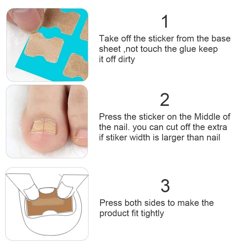 1 Set Miếng Dán Chỉnh Hình Móng Chân Mềm Mại Đàn Hồi Tự Dính