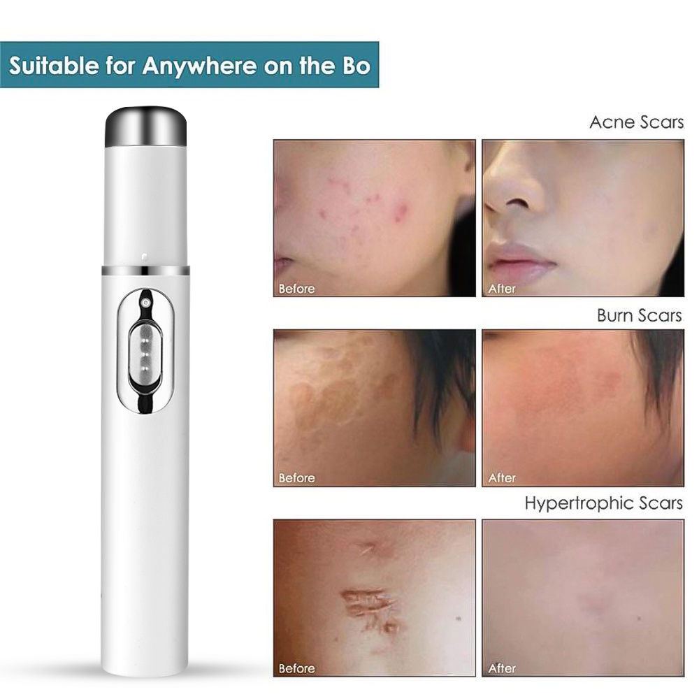 Bút Xóa Sẹo Bằng Tia Laser Ánh Sáng Xanh Mềm Mại Giúp Thư Giãn KD-7910