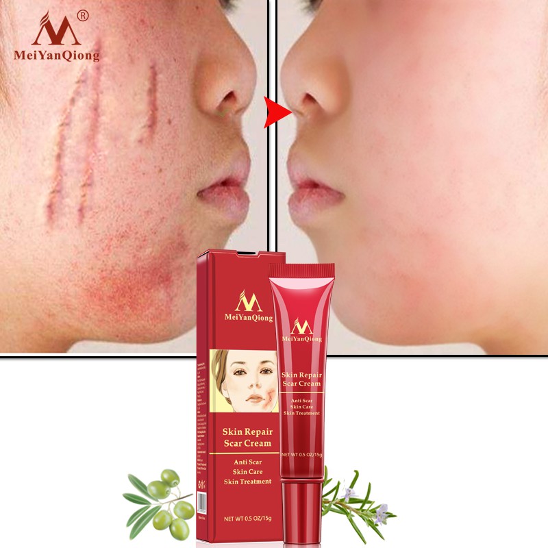 MeiYanQiong Acne Scar Removal Cream Skin Repair Stretch Marks giảm sẹo lồi, lõm, sẹo thâm, do mụn giúp phục hồi các tổn thương trên da thúc đẩy tái tạo da 15ml