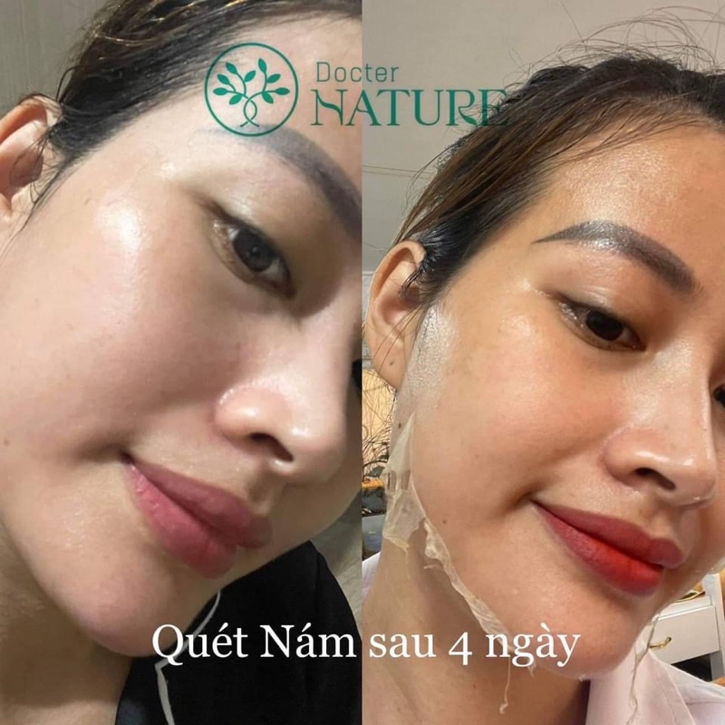 QUÉT NÁM  DR.Nature Peel skin Diamond(tái tạo trẻ hoá da,sáng căng bóng,mờ thâm nám xạm,nhỏ lcl,dùng mọi loại da,...