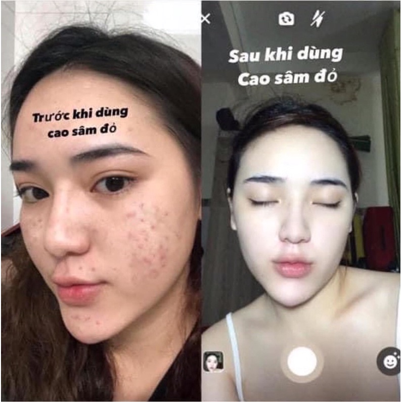 [Chính hãng] Cao mụn sâm đỏ 36 vị full 15g _Cam kết chính hãng 100%