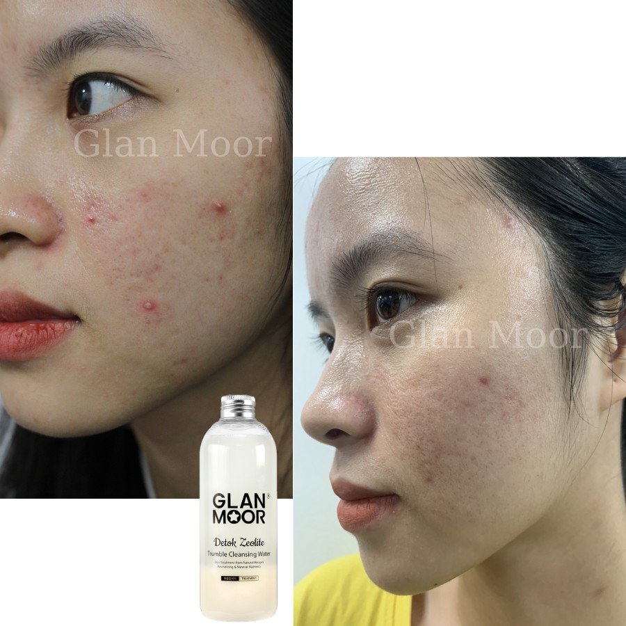 Nước Tẩy Trang Thải Độc Tố GLAN MOOR Detok Zeolite Trumble Cleasing Water